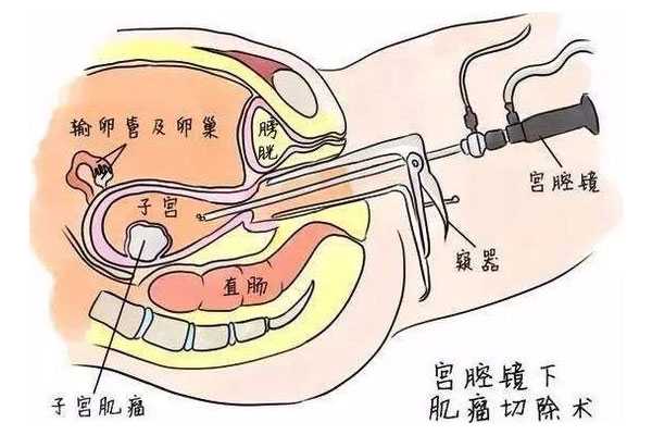 上海供卵公司成功率_宫腔镜手术和腹腔镜手术不是一回事术后要注意什么？